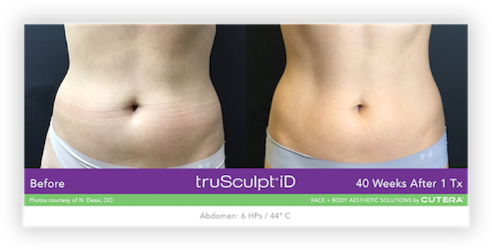 truSculpt® iD Before After 5